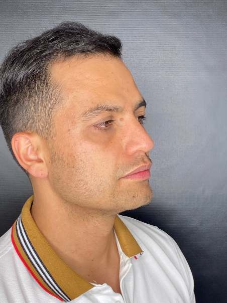 Antes - Bolsas y Ojeras