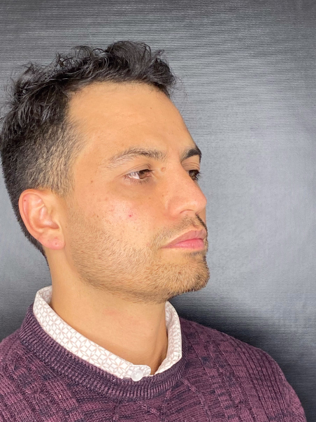 Después - Bolsas y Ojeras