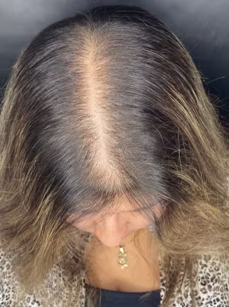 Before Hair Therapy - Recovery