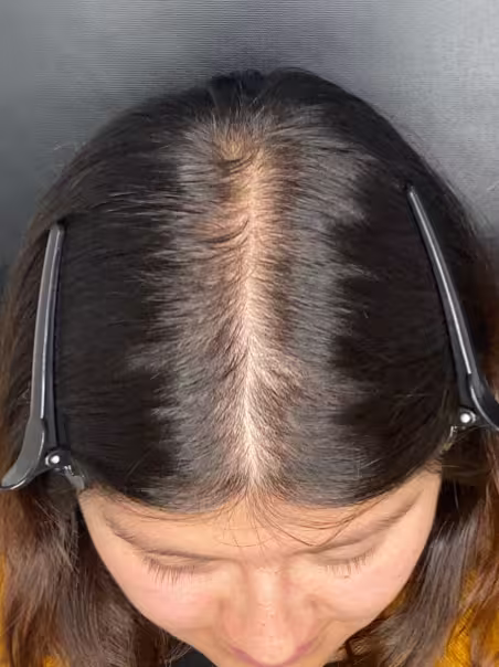 After Hair Therapy - Recovery
