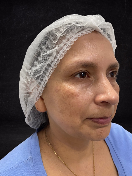 Antes - Blanqueamiento de Manchas