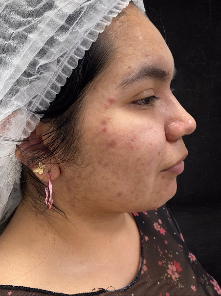 Antes - Eliminación de Hiperpigmentación