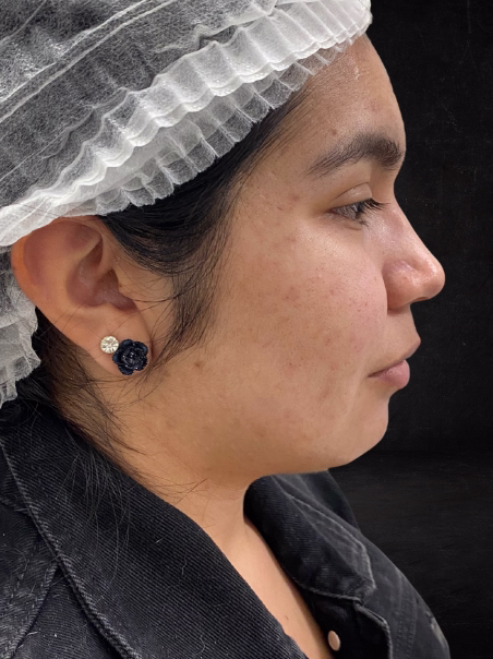 Después - Eliminación de Hiperpigmentación