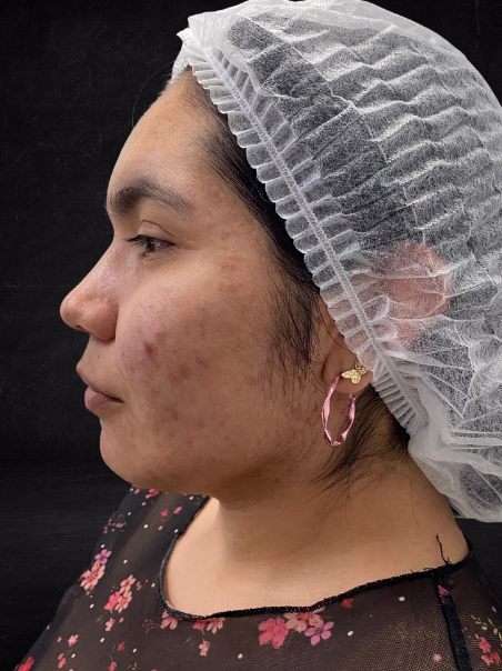 Antes - Tratamiento de Manchas de Edad