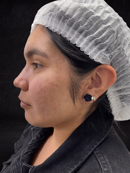 Después - Tratamiento de Manchas de Edad