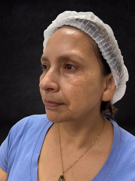 Antes - Limpieza de Manchas Oscuras