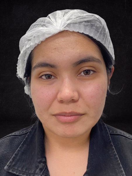 Después - Eliminación de Manchas Solares