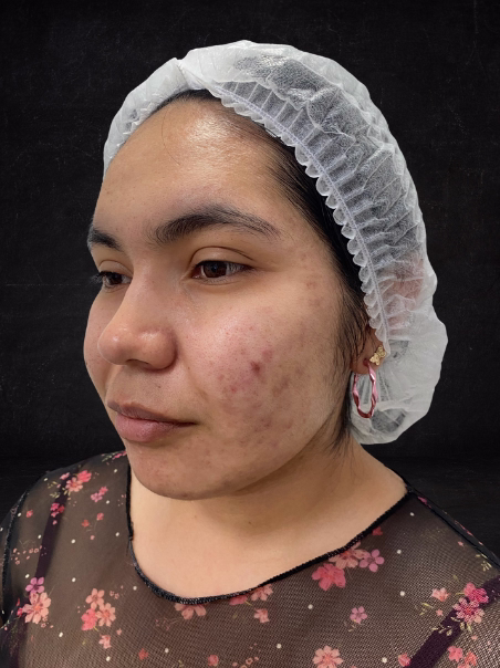 Antes - Reducción de Pecas