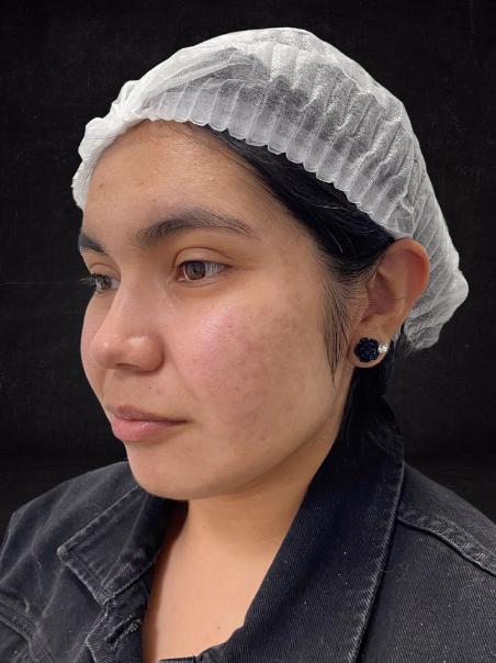 Después - Reducción de Pecas