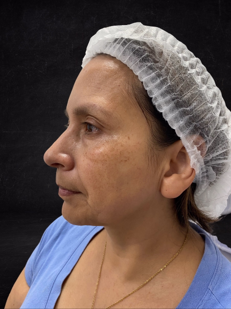 Antes - Tratamiento de Pecas en Rostro