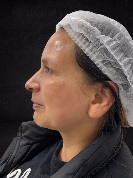 Después - Tratamiento de Pecas en Rostro