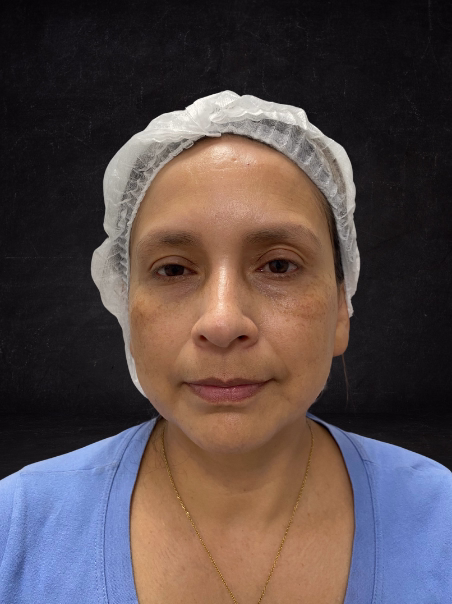 Antes - Rejuvenecimiento Facial