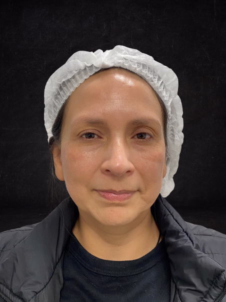 Después - Rejuvenecimiento Facial