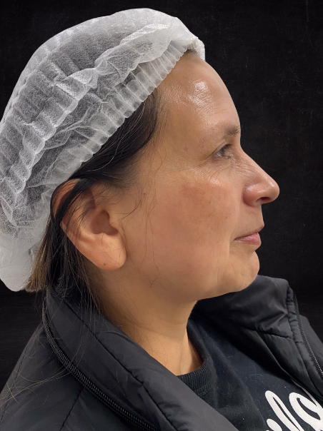 Después - Renovación de la Piel