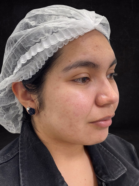 Después - Unificación del Tono de Piel