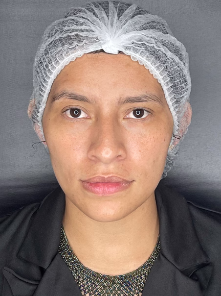 Before Pigment reduction