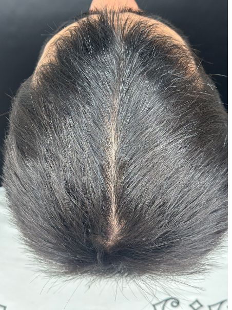 Después - Aumento de Cabello