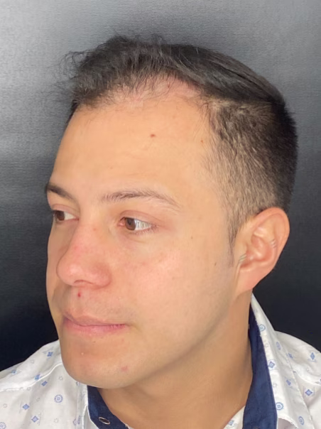 Before Hair Implant