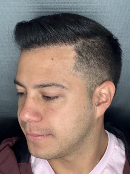 After Hair Implant