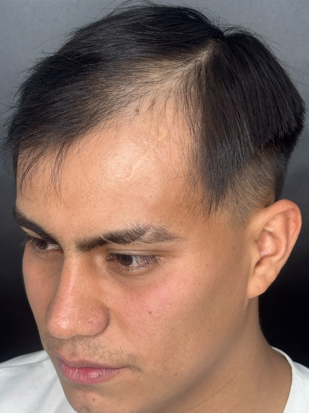 Antes - Cobertura Completa