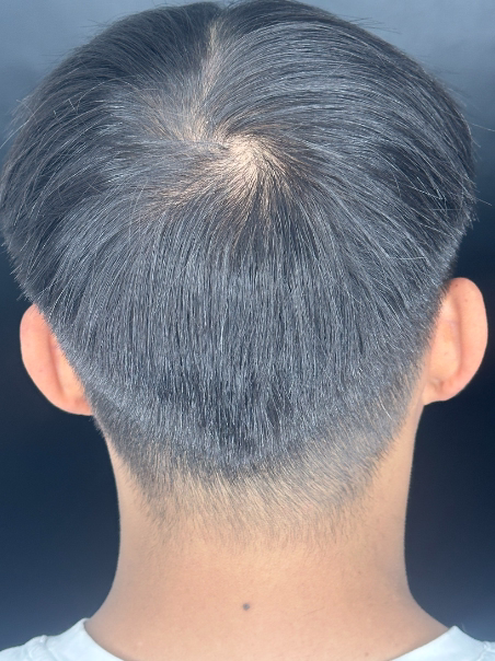 Antes - Coronilla Más Llena