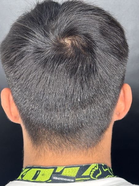 Después - Coronilla Más Llena