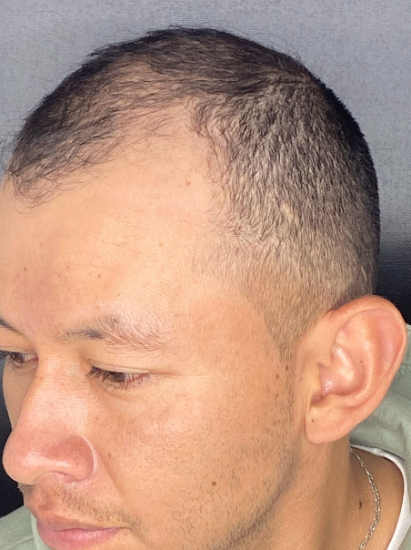 Antes - Densificación Total