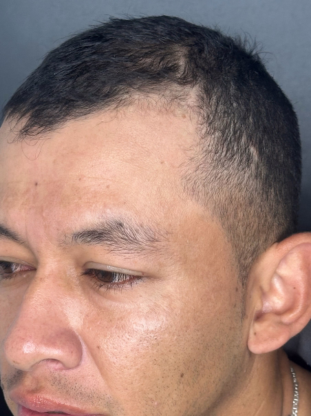 Después - Densificación Total