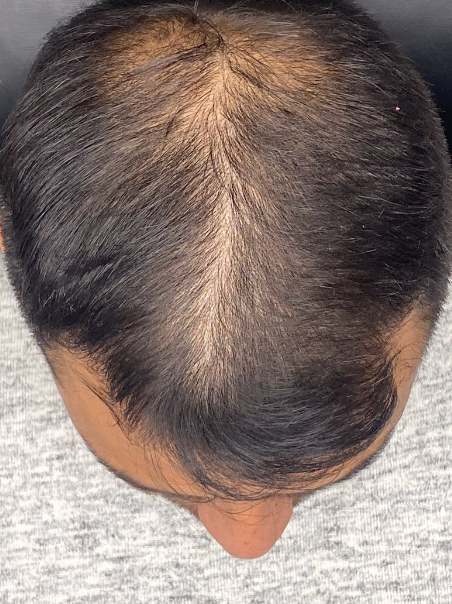 Antes - Resultado Inmediato