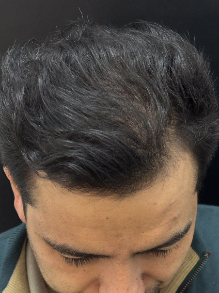 Después - Resultado Inmediato