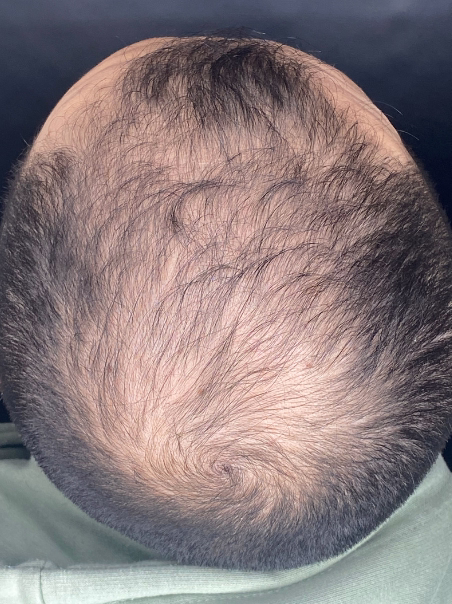 Antes - Mejora Integral