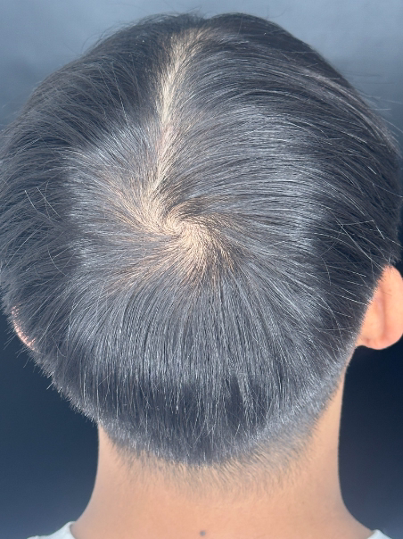 Después - Resultado Natural