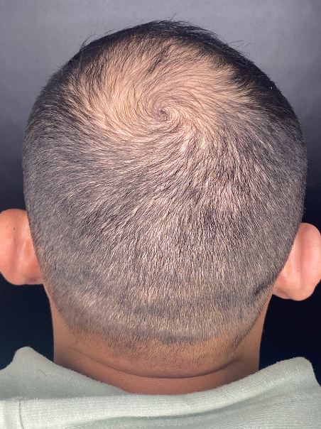 Antes - Cabello Permanente