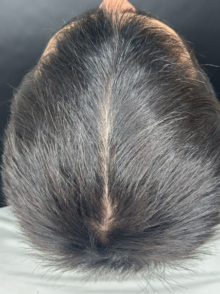 Después - Recuperación de Cabello