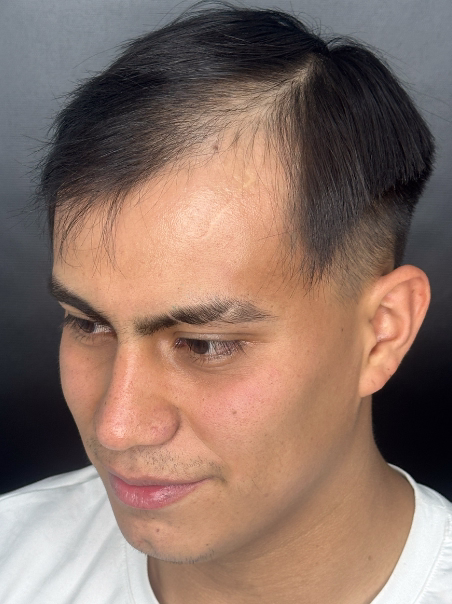 Antes - Restauración Capilar