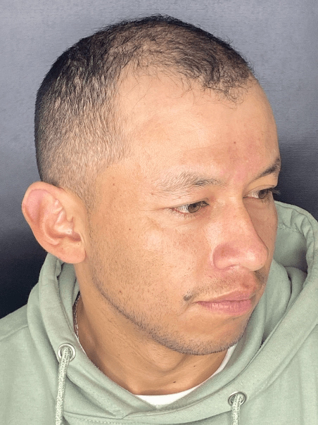 Antes - Cabello Saludable