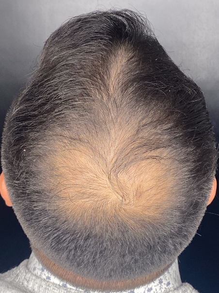 Antes - Transformación Total