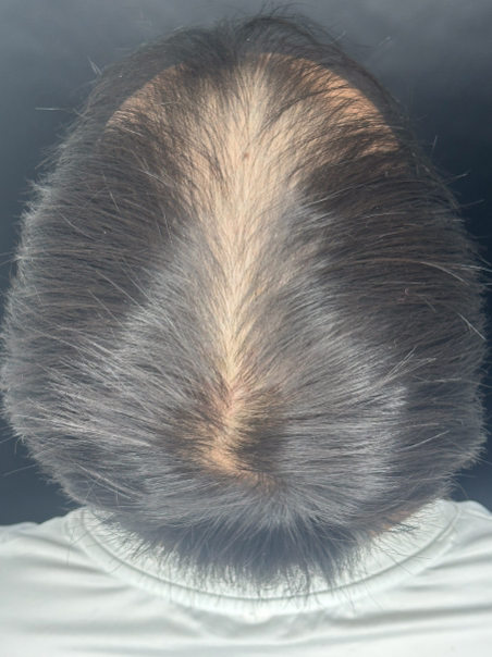 Antes - Transformación Capilar