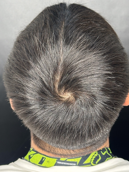 Después - Transformación Capilar