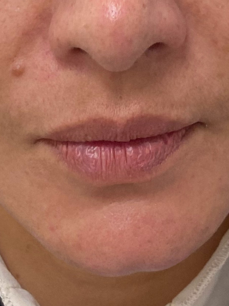 Before - Cupid's Bow Definition