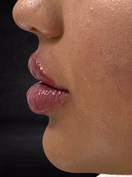 After - Asymmetry Correction