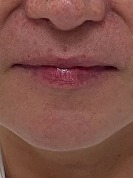 Before - Lip Enhancement
