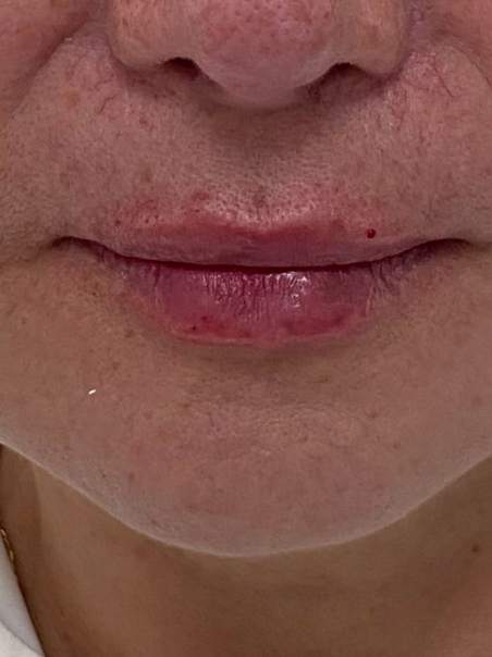 After - Lip Enhancement