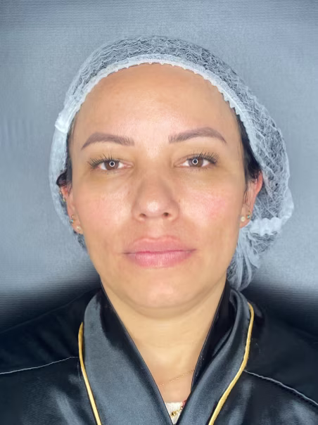 Before Lip enhancement
