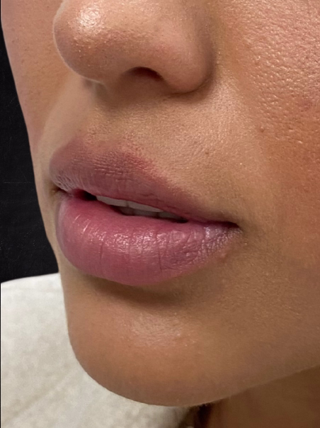 Before - Lip Border Definition