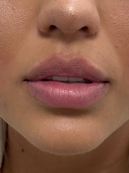 Before - Corner Lift