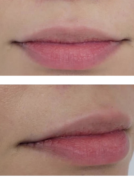 Before - Lip Contour