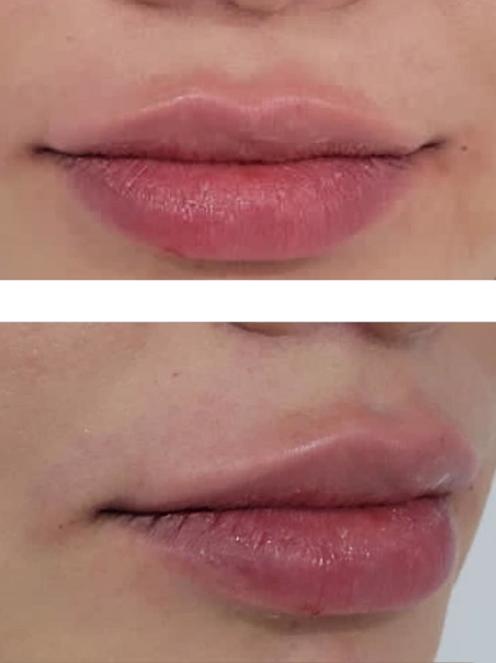 After - Lip Contour