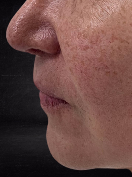 Before - Fuller Lips