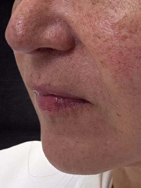 Before - Lip Hydration - Case 3